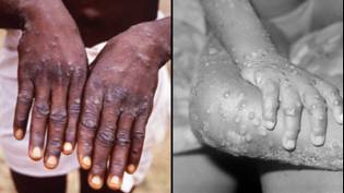 Australia Detects First 'Probable' Case Of Monkeypox With Patient Now In Isolation