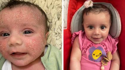 Little girl with painful eczema now has ‘baby soft skin’ thanks to £8 cream