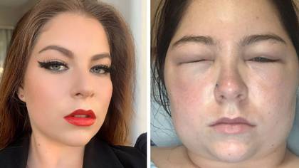 Woman says she nearly died after severe allergic reaction to hair dye