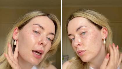 Woman shares result of not wearing suncream when driving