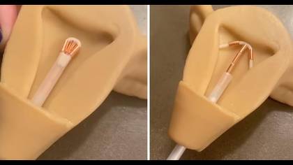 Video shows the painful reality of IUD implants