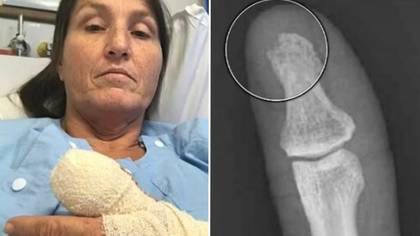Horror as woman told she could lose a thumb after terrible mistake during manicure