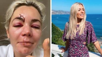 A Place In The Sun star Danni Menzies shares shocking injuries after moped crash