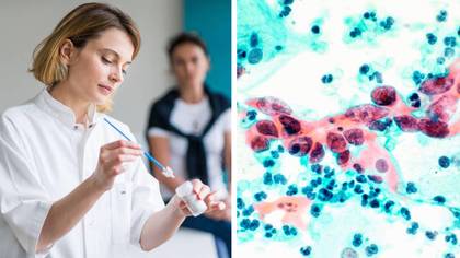 Scientists have developed more accurate test for cervical cancer