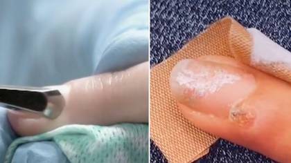 Doctor believes manicure gave woman cancer under her fingernail
