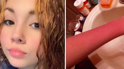 Teen with super rare condition is allergic to her own tears