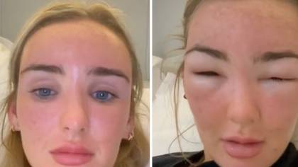 Woman's face becomes unrecognisable after suffering shocking effects of sun poisoning