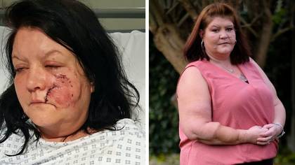 Woman who almost lost her arm in dog attack says bring back licences