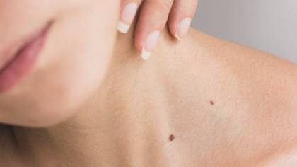 How To Spot A Cancerous Mole