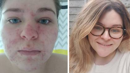 Mum who became a recluse due to acne now feels ‘free’ after finding ‘life-changing’ cure