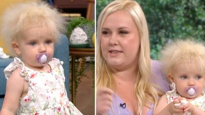 Little Girl Diagnosed With Uncombable Hair Syndrome