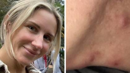 Woman praises cheap new drug for completely clearing her 'horrible' acne in just weeks