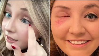 Woman issues urgent warning after she loses eye in minor car accident