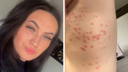 Furious mum claims she was riddled with '150 bed bug bites' after stay at 'mouldy and dusty' Butlin's