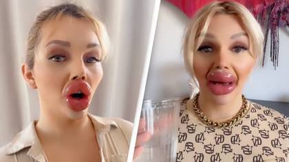 Woman who has undergone massive lip injections admits it's difficult to eat and drink
