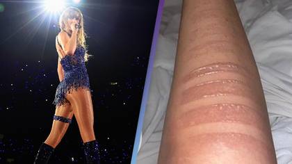 Fans were treated for second-degree burns after attending Taylor Swift’s concert in Brazil