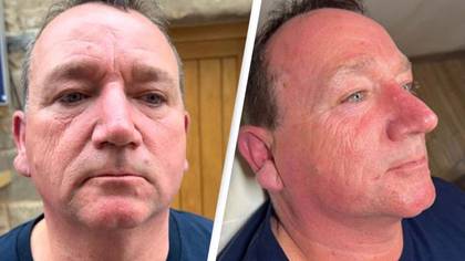 Truck driver who never wore sunscreen shows dramatic difference it's made to one side of his face