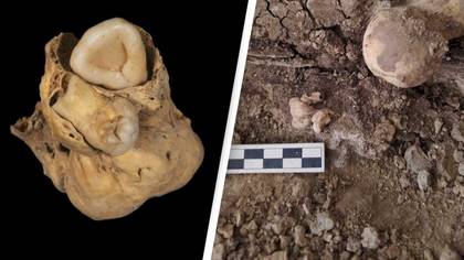 Tumor with teeth found in pelvis of ancient Egyptian woman