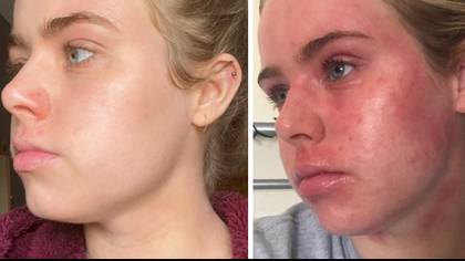 Woman Reveals How She Cleared Up Her Chronic Eczema After 22 Years With £18 Product