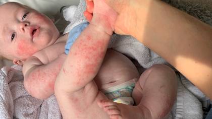 Woman Praises £18 Lotion For Clearing Up Baby's Severe Eczema