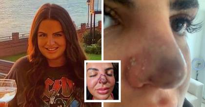 Woman Issues Warning After Nose Filler Starts Rotting
