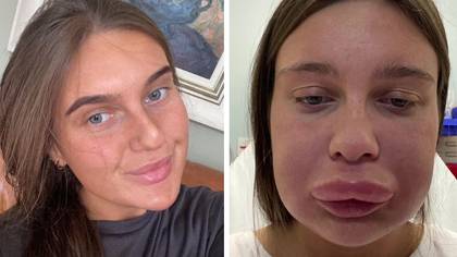 Woman rushed to hospital and left 'looking like Donald Duck' after getting lips dissolved