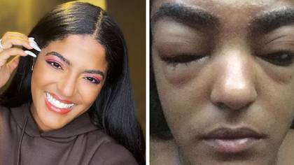 Woman left fearing for her sight after severe allergic reaction to eyebrow dye
