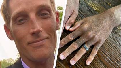 Mystery as anti-depressant drug changes man’s skin colour from white to dark grey