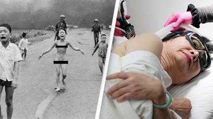 Iconic 'Napalm Girl' From Vietnam War Gets Final Burns Treatment