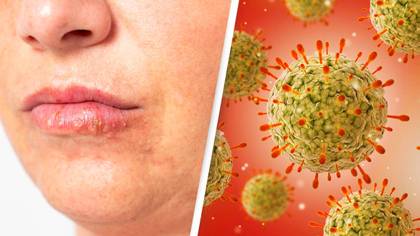 Genetically-engineered herpes is helping to beat cancer