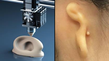 医生成功地移植了由人类细胞制成的3D印刷耳朵
