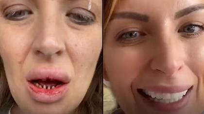 女人在恐怖经历之后向人们发出严重警告，在土耳其获得廉价的牙科工作