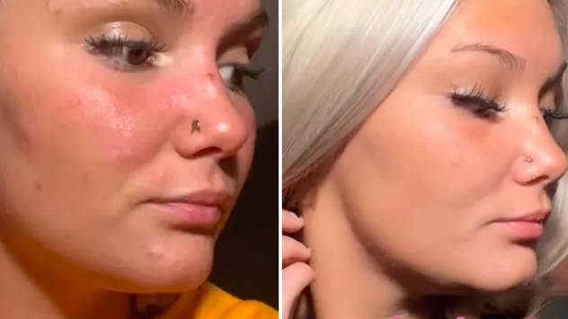 Woman shares before and after results of using anti-dandruff shampoo to get rid of pimples