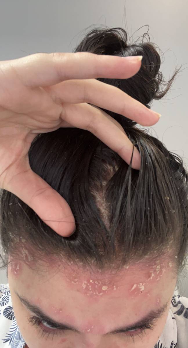 Student's Stark Vaping Warning After Habit Triggered Skin Condition