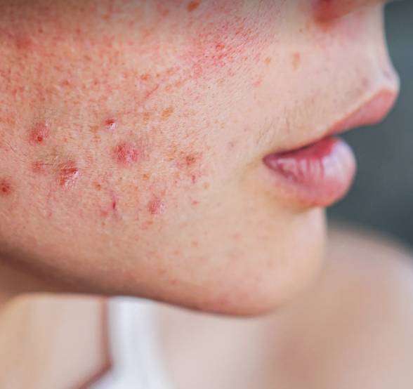 Acne affects 95% of people across the UK at some point (Credit: Shutterstock)