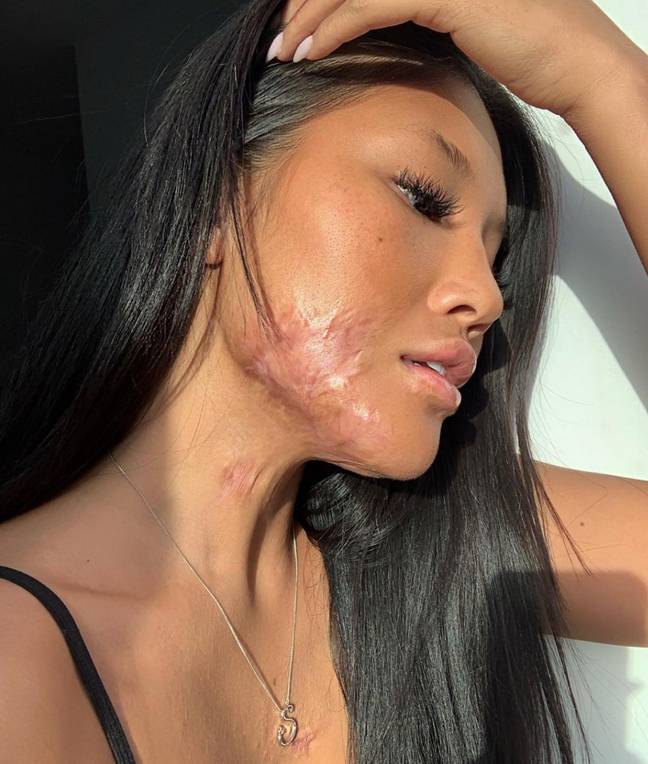 Sophie embraces the beauty of her remaining scars. Credit: Instagram/@sophirelee