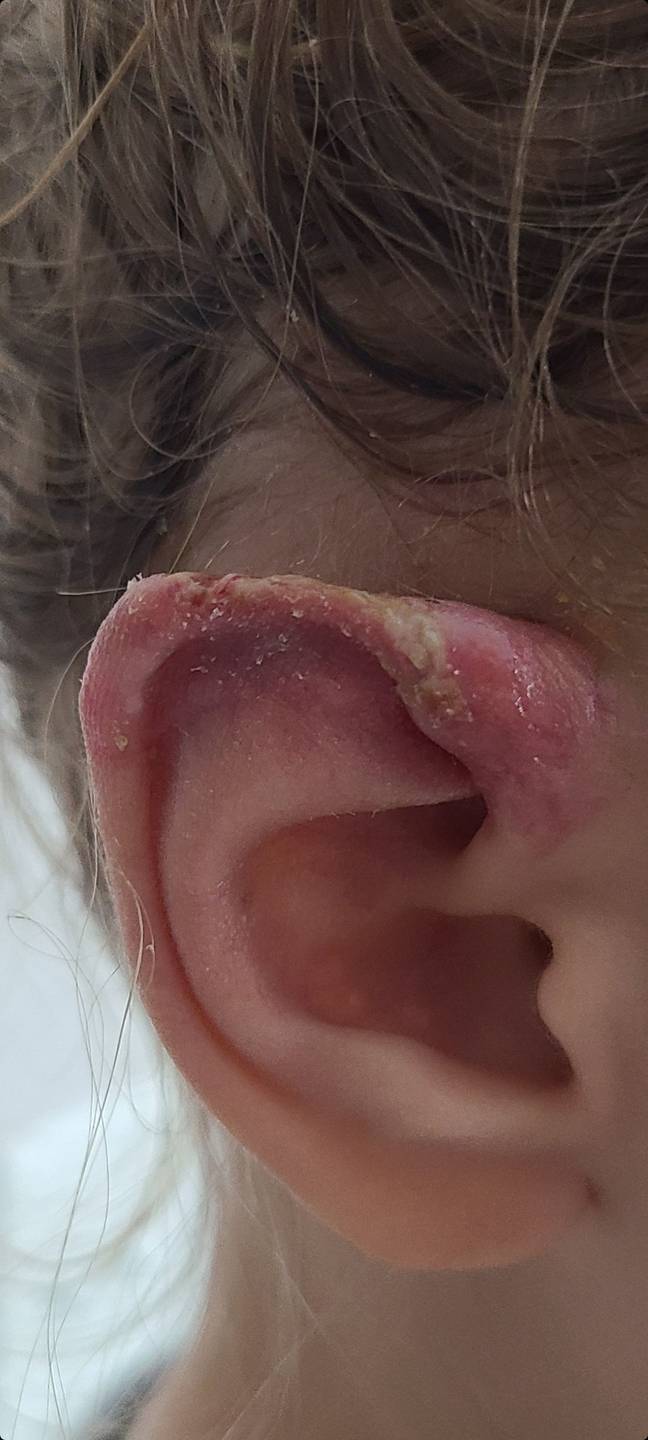 The dog bit off the top of Kenzie's ear. Credit: Kennedy News and Media