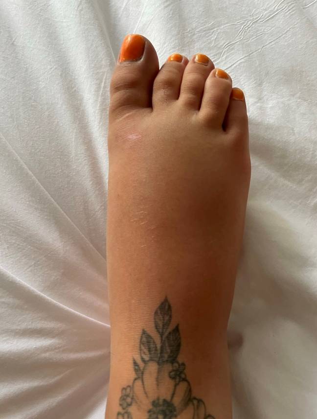 Amy's foot doubled in size. Credit: SWNS