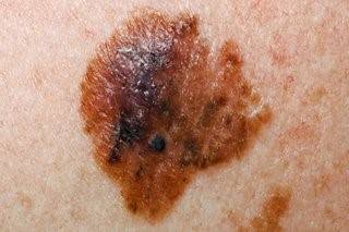 Check to see if your mole with an uneven border (Credit: NHS)