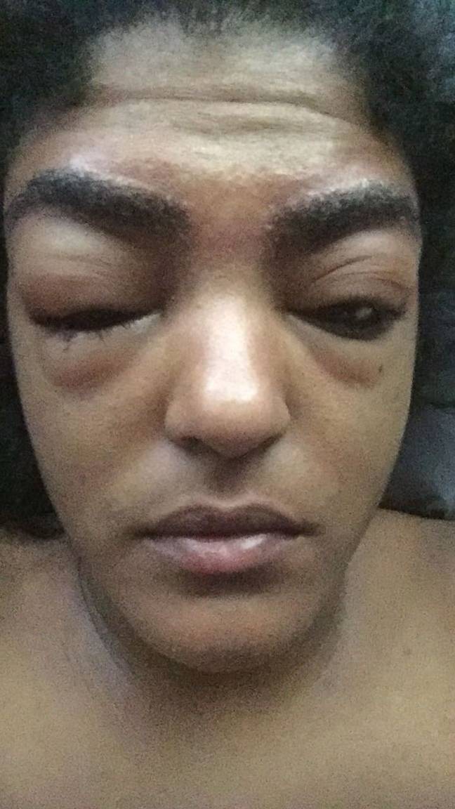 Jackii suffered a severe allergic reaction. Credit: Kennedy News and Media