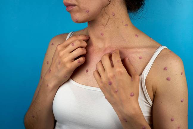 The monkeypox virus causes lesions on the skin. Credit: lempix.photos/Alamy Stock Photo