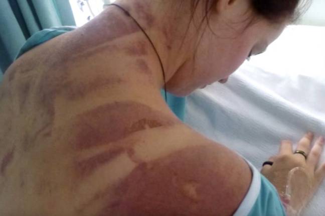 TrivDaily - Woman who fell 360 feet after bungee cord snapped shares images of her injuries after hitting crocodile-infested water 60 She was badly bruised by the fall. Credit: YouTube/Erin Langworthy