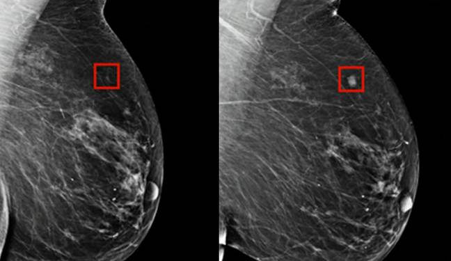 The image on the left shows something the AI identified as cancer, on the right is four years later as it started to develop. Credit: Lauder Breast Center at the Memorial Sloan Kettering Cancer Center/CNN