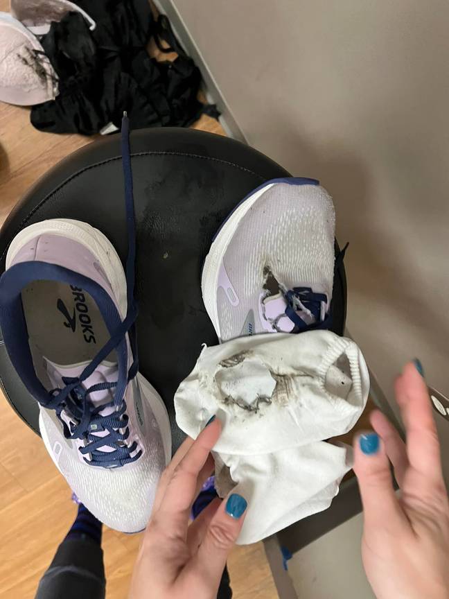 The lightning tore a hole through one of Emma's socks and shoes. Credit: Facebook/Erin Eggler
