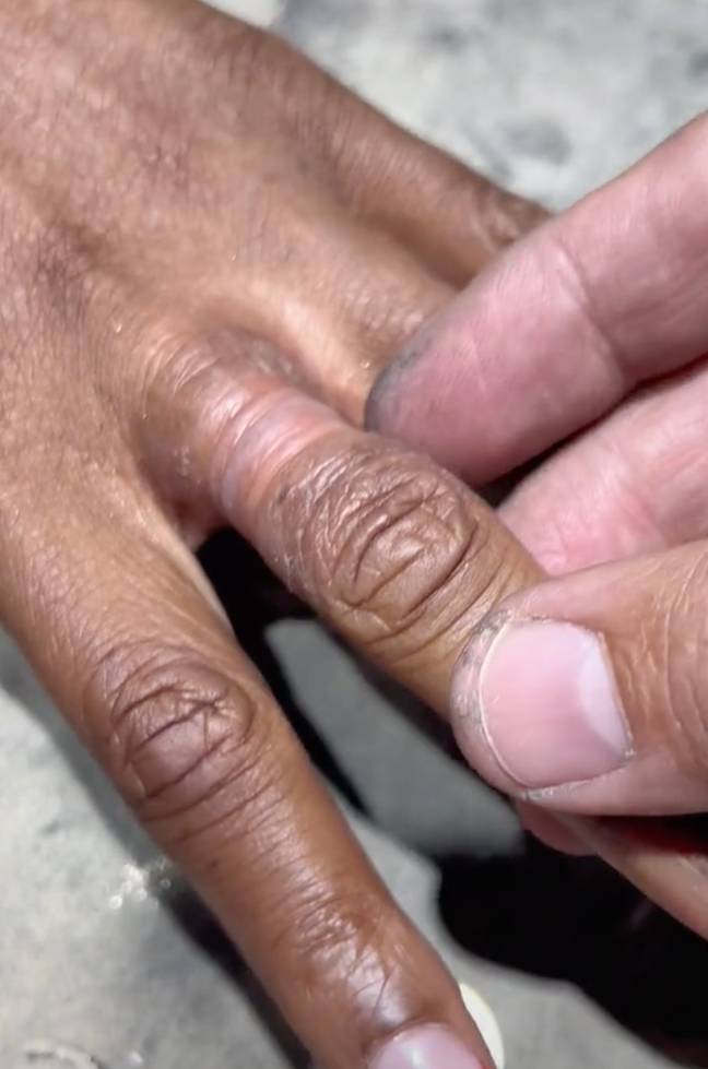 The woman's finger will take a few weeks to heal. Credit: TikTok/@jewelleryforever