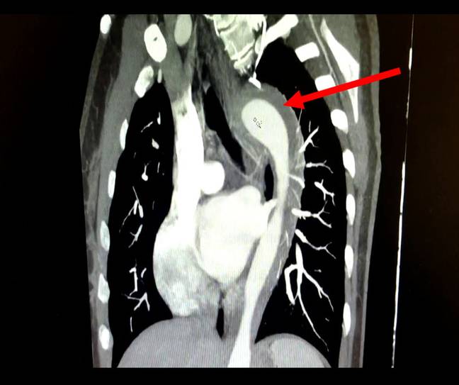 This scan of the chest shows how the leaking aorta has affected the body. Credit: American Journal of Case Reports