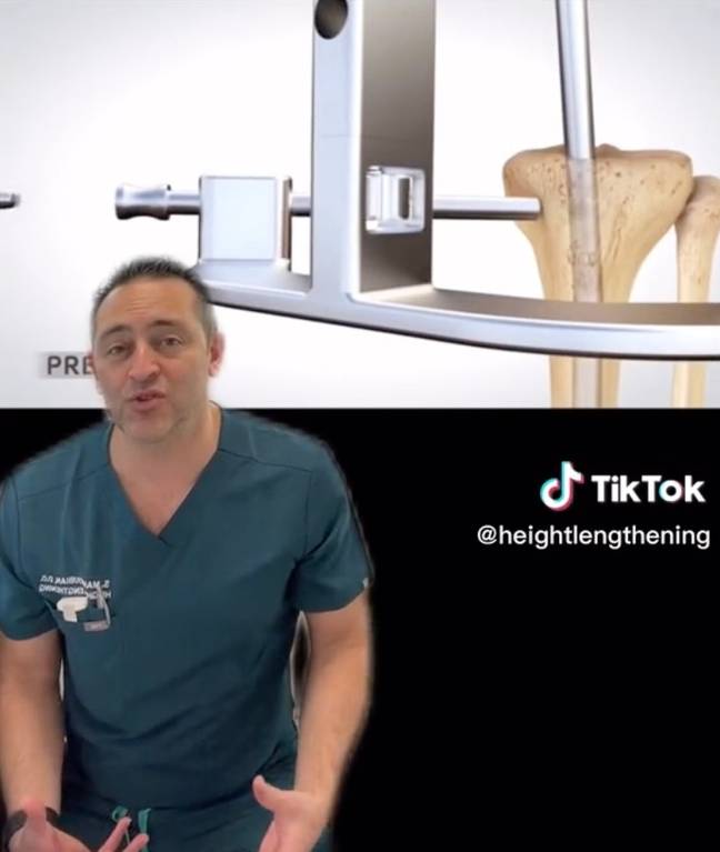 A metal rod is placed inside the bone and is lengthened bit by bit. Credit: TikTok/@heightlengthening 