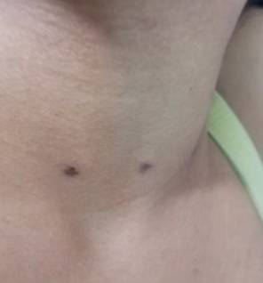 These are her the marks on her daughter's neck. Credit: @tateasa/TikTok