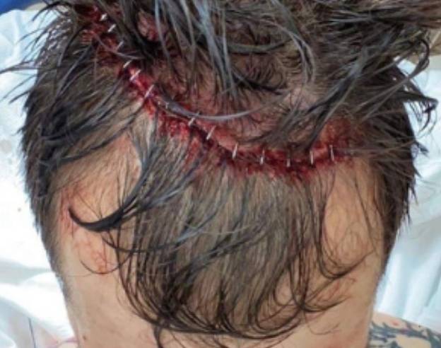 The wound required 17 staples to close (Image: MyMMANews)