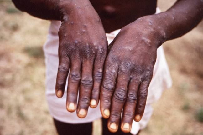 A chief medical adviser has warned of more UK cases of monkeypox. Credit: Alamy